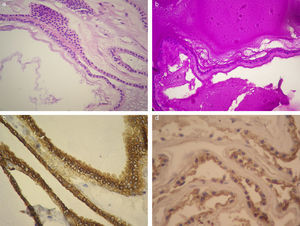 En la histopatología (400 X) se observa una lesión quística tapizada por epitelio cuboidal con núcleos esféricos con leve pleomorfismo, (a) citoplasma acidófilo y (b) material amorfo PAS positivo. La inmunomarcación fue positiva para (c) citoqueratina 7 y (d) antígeno carcinoembrionario.