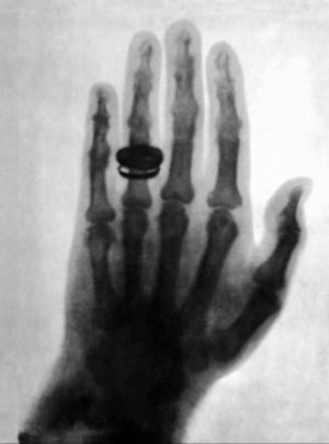 Radiografía de la mano del anatomista Albert von Kölliker obtenida por el mismo Röntgen el 23 de enero de 18962.