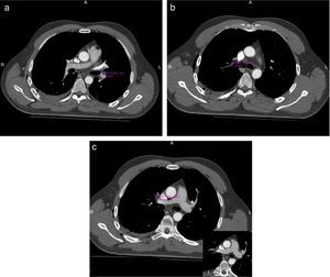 (a, b y c) TCMD de tórax con contraste endovenoso. Se observa el defecto de relleno con valores tomodensitométricos negativos a nivel de los ramos lobares y segmentarios de las arterias pulmonares.