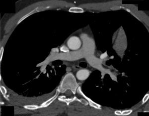 TCMD de tórax con contraste endovenoso y reconstrucción multiplanar. Se evidencia el defecto de relleno con valores tomodensitométricos negativos a nivel de los ramos lobares y segmentarios de las arterias pulmonares.