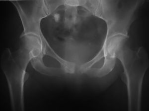 Radiografía de pelvis: se observan signos de rarefacción y destrucción ósea de la rama pubiana izquierda con esclerosis parcial de la rama derecha, diastasis de la sínfisis pubiana y calcificación inespecífica en la porción superior de la pelvis.