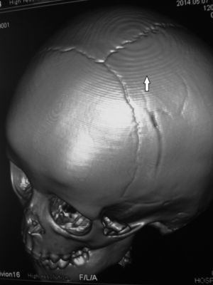 TC de cráneo, reconstrucción 3D, en ventana ósea: en el extremo superior de la calota se evidencia un artificio concéntrico y escalonado (flecha).