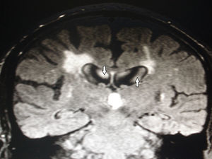 RM de cerebro, corte coronal FLAIR: se visualizan hiperintensidades en el interior de los ventrículos laterales debido a las pulsaciones del líquido cefalorraquídeo (flechas).