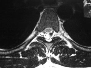 RM de columna dorsal, corte axial, en ponderación T2: dentro del saco tecal y detrás de la médula espinal, se distinguen imágenes tubulares hipointensas que corresponden a artefactos de pulsación del líquido cefalorraquídeo (flechas). No deben confundirse con estructuras vasculares.