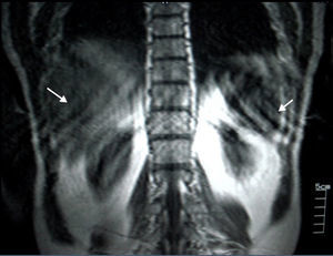 RM de abdomen, corte coronal, en ponderación T1: se detectan artefactos de movimiento respiratorio por taquipnea causada por la angustia del paciente durante el estudio (flechas).