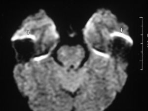 RM de cerebro, corte axial, con difusión: se identifican hiperintensidades en la topografía de los lóbulos temporales por artificio de los peñascos (flechas). Corresponde al artificio de susceptibilidad magnética.
