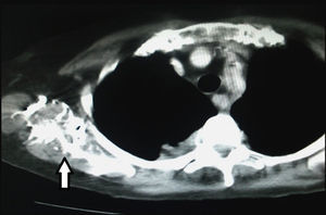 TC de tórax con contraste endovenoso, corte axial, en ventana mediastino: artificio generado por el contraste en la región axilar derecha, como consecuencia de un escaneo precoz (flecha).