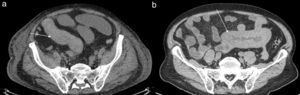 (a y b) Imágenes axiales de tomografía computada en dos pacientes distintos con hematoma intramural intestinal espontáneo. Se evidencian engrosamientos hiperdensos, circunferenciales y homogéneos de la pared de un segmento intestinal (flechas), compatibles en ambos casos con hematoma intramural.