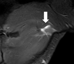 Desgarro muscular del pectoral mayor. La secuencia en ponderación STIR, plano coronal, muestra la rotura fascicular del pectoral mayor a nivel de su inserción en el húmero, siendo esta la localización más frecuente (flecha).