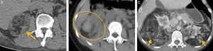 (a) En la TC sin contraste se observa una imagen cortical heterogénea con densidad predominantemente grasa en el polo superior del riñón derecho, compatible con un angiomiolipoma (flecha). (b) Se identifica un área espontáneamente densa en su interior, que corresponde a material hemático, producto de su sangrado (círculo). (c) Se muestran angiomiolipomas bilaterales en una mujer de 60 años con esclerosis tuberosa (flechas).
