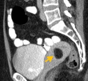 Lipoleiomioma. En la TC con contraste en corte sagital se aprecia a nivel de la pared uterina una imagen redondeada y bien definida, con densidad grasa (flecha) y sin realce poscontraste, que corresponde a un tumor uterino de estirpe lipomatosa.