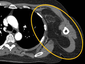 Liposarcoma axilar gigante bien diferenciado. La TC con contraste muestra a nivel axilar una masa voluminosa con densidad grasa, que desplaza los planos musculares y presenta escasos tractos densos y heterogéneos en su interior (círculo).