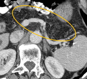Infiltración lipomatosa difusa del páncreas. En la TC con contraste la glándula pancreática permanece hipodensa luego de la administración del contraste, debido a la infiltración grasa difusa que contrasta con el realce de los tractos vasculares (círculo).