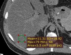 Esteatosis hepática. En la TC sin contraste se identifica un hígado marcadamente hipodenso (11 UH) e hiperdensidad espontánea de los vasos en relación con el parénquima.