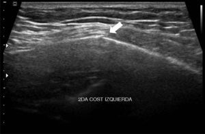 Ecografía de la pared costal, realizada por dolor y ante la sospecha de desgarro muscular, en la que se reconoce angulación y disrupción de la cortical ósea (flecha), relacionable con fractura costal.