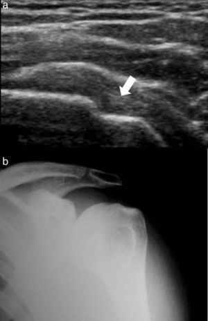 (a) Ecografía del manguito rotador izquierdo muestra en la exploración del tendón del infraespinoso un defecto superficial en forma de cuña en la cortical ósea humeral (flecha). (b) La radiografía certifica una lesión Hill-Sachs.