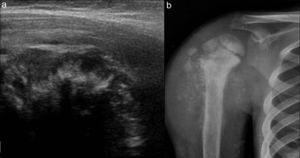 (a) Ecografía de partes blandas del hombro en un niño de 10 años, realizada por tumoración y dolor, evidencia una reacción perióstica en rayos de sol. (b) Correlación radiográfica. Diagnóstico: osteosarcoma.