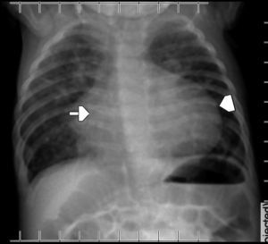 Radiografía de tórax portátil en la que se advierte un aumento de la aurícula (flecha) y el ventrículo derechos (cabeza de flecha), configurando el corazón en bota.