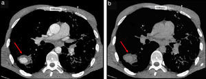 Cortes axiales de tomografía computada en ventana de mediastino muestran en el lóbulo inferior derecho una lesión de bordes bien definidos, (a) con captación de contraste en fase arterial y (b) lavado en la fase venosa (flechas).