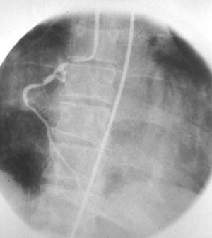 Coronariografía derecha por cateterismo femoral.