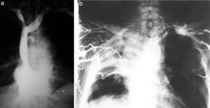 (a) Cavografía normal. (b) Tumor de pulmón con obstrucción de la cava y circulación colateral.