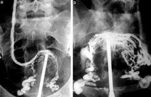 (a y b) Flebografía pelviana evidencia várices en los plexos venosos.