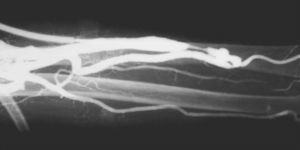 Angiografía de acceso vascular para hemodiálisis muestra estenosis de la vena de retorno proximal a la anastomosis.
