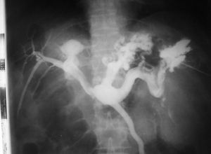Esplenoportografía identifica várices en el techo gástrico. La radiografía fue tomada con cambiador automático 35 x 35 (1976).