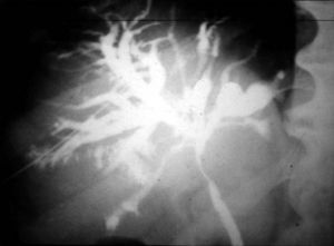 Colangiografía percutánea transparietohepática evidencia una estenosis del conducto hepático común (tumor de la encrucijada).
