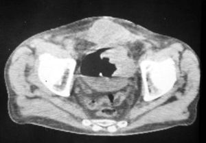 Prehistoria de la TC (circa 1978). “Doble contraste” vesical para delimitar un tumor vesical.