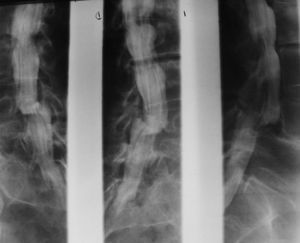 Mieloradiculografía muestra discopatía L3-L4 y escalón por espondilolistesis L4-L5.
