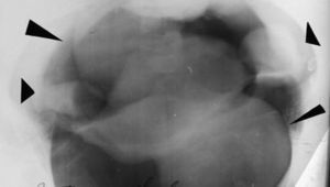 Neumopelvigrafía revela ovarios (flechas cortas) y miomas uterinos (flechas largas).