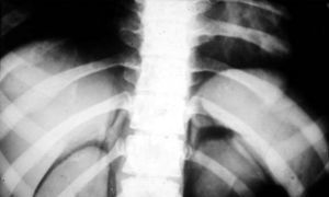 Neumoretroperitoneo para ver las glándulas suprarrenales.