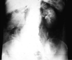 Neumoretroperitoneo más urograma muestra un tumor renal derecho.