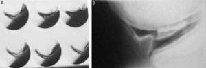 Artoneumografía de (a) rodilla normal y (b) fractura de menisco.