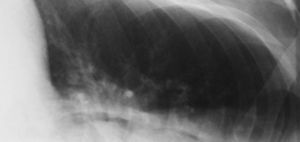 Neumoaurícula. Paciente en decúbito lateral izquierdo con nivel hidroaéreo entre el CO2 y la sangre. Se observa un espesor mayor de 2mm entre el aire auricular y pulmonar por un derrame pericárdico.