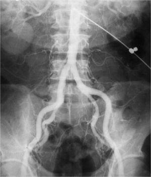 Aortografía por punción translumbar con aguja rígida (circa 1972).