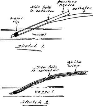 Dibujo personal de Seldinger en sus “cinco segundos” (1952).