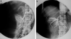 (a y b) Cateterismo selectivo de la arteria y la vena suprarrenal muestra un adenoma.