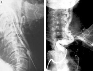(a y b) Arteriografía carotídea por punción y cateterismo. Nótese el espasmo de la carótida interna en la punción.