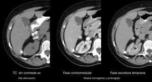 Tomografía computada de un angiomiolipoma renal atípico (flechas): patrón y realce en el tiempo.