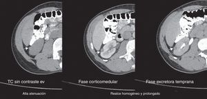 Tomografía computada de un angiomiolipoma renal atípico (flechas): patrón y realce en el tiempo.