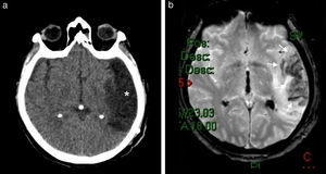 (a) Paciente con cefalea tras un accidente cerebrovascular isquémico en el territorio silviano izquierdo (asterisco). (b) En la RM en secuencia GRE, plano axial, se observan áreas de hipointensidad (flechas) que indican transformación hemorrágica.