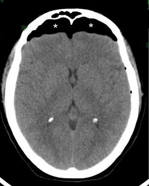 Cefalea en el posquirúrgico inmediato. La TC en corte axial identifica la presencia de un neumoencéfalo bifrontal (asteriscos). Nótese el desplazamiento del parénquima encefálico y el tamaño pequeño de los ventrículos laterales por el efecto de masa generado.