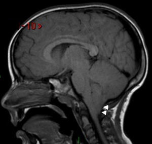 Cefalea de larga data en niña de 6 años de edad. La RM en ponderación T1, en corte sagital, muestra el descenso de las amígdalas cerebelosas (puntas de flecha) a través del agujero magno, un signo vinculable a la malformación de Arnold-Chiari.
