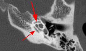 Varón de 30 años con un acúfeno pulsátil en el oído izquierdo. La TC del peñasco izquierdo en el plano axial muestra bandas hipodensas confluentes en la cápsula ótica izquierda que rodean la cóclea, formando el signo del doble anillo de la otosclerosis (flechas). Los hallazgos son compatibles con otoespongiosis retrofenestral o coclear.