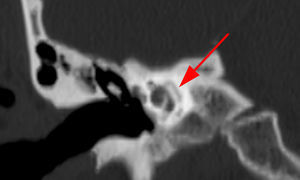 La TC del peñasco derecho del mismo paciente evidencia el signo del doble anillo de la otosclerosis en el plano coronal (flecha).