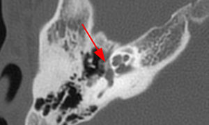 Mismo paciente de las figuras 1 y 2. La TC del peñasco del lado derecho en el plano axial detecta un área hipodensa en la parte anterior del vestíbulo (fissula ante fenestram), demostrando la asociación de la otosclerosis coclear con la fenestral (flecha).