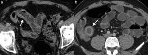 Enfermedad de Crohn en una mujer de 71 años con cambios inflamatorios agudos. (a) Imagen axial de enterografía por TC con medio de contraste que muestra engrosamiento mural del íleon distal, con 7mm de grosor (flecha). (b) Imagen axial de enteroclisis por tomografía computada con medio de contraste que evidencia el engrosamiento y realce de las paredes del íleon distal (flecha).