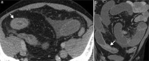 Paciente con enfermedad de Crohn en fase fibroestenótica. (a y b) Planos axial y coronal de tomografía de abdomen que identifican engrosamiento de las paredes del íleon distal (flechas), con dilatación de las asas intestinales delgadas proximales y líquido libre por proceso obstructivo. Nótese la proliferación fibrograsa adyacente al íleon distal comprometido.